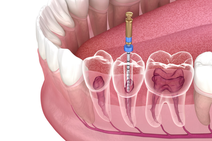 endodonzia (1)