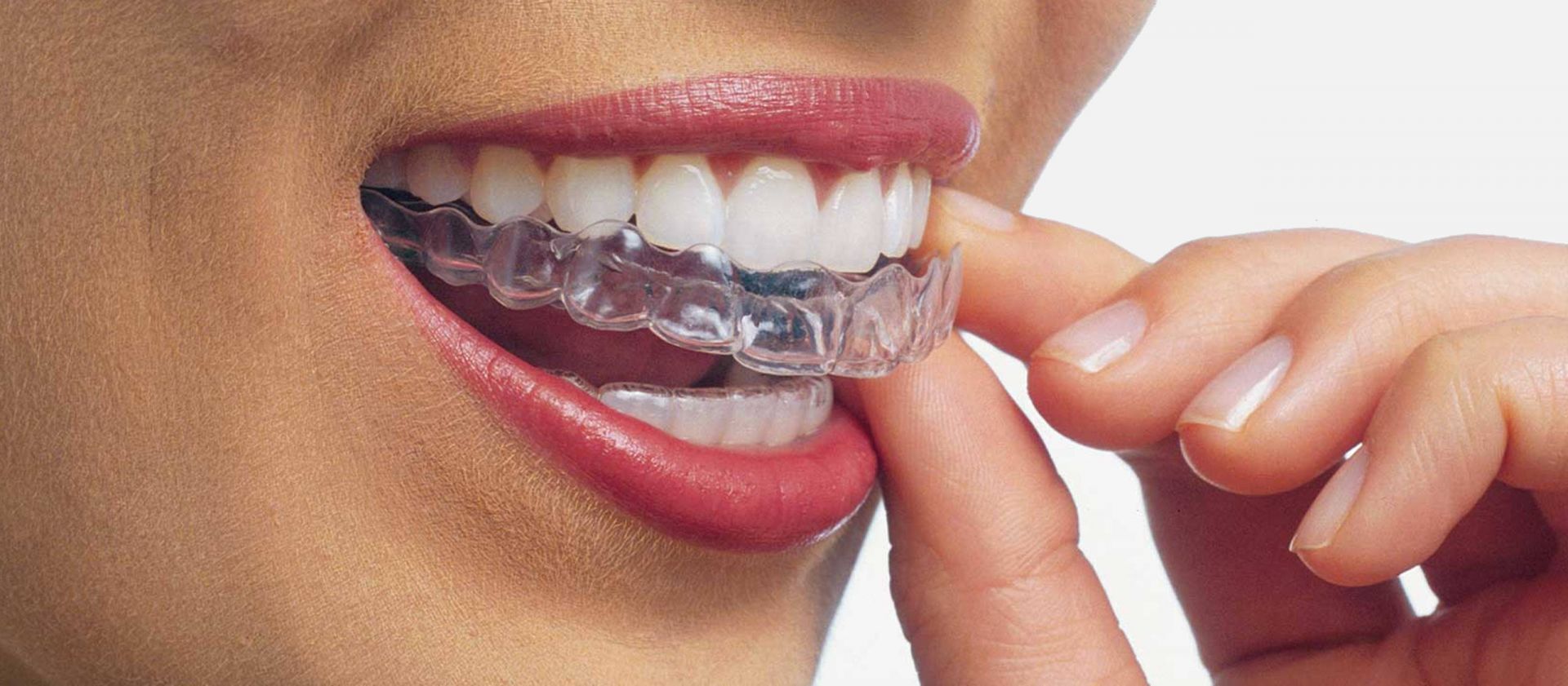 ortodonziatradizionaleinvisalign (1)